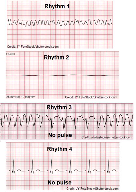 Pulseless Electrical Activity (PEA) ECG/EKG Quiz