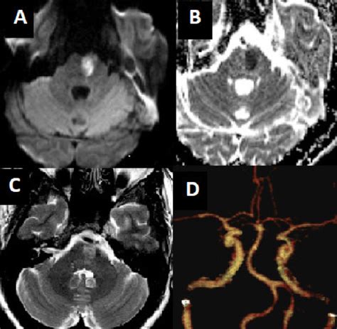 Brain MRI showed acute left paramedian lower pontine infarct. A ...