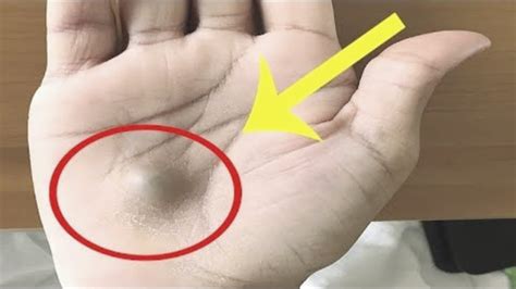 A Man Found This Strange Lump On His Palm Then A Scan Revealed The True ...