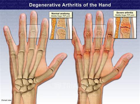 Degenerative Arthritis of the Hand - TrialExhibits Inc.