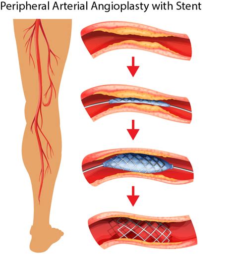 Peripheral Arterial Angioplasty Stent Placement - Elite Cardiovascular ...