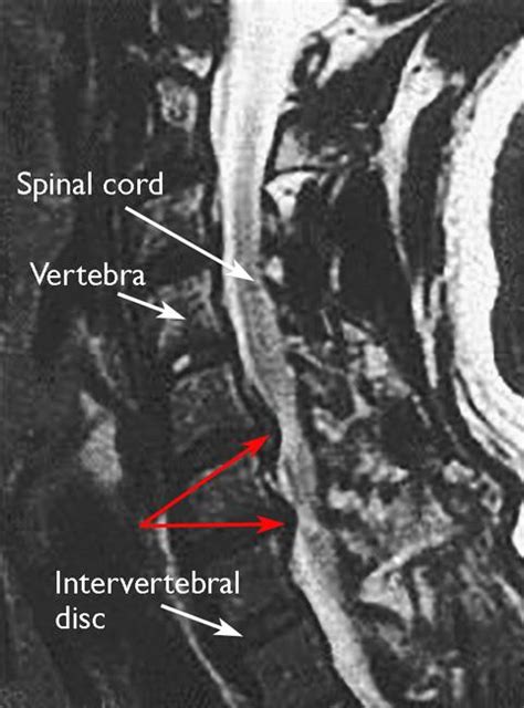 Cervical Radiculopathy (Pinched Nerve) - OrthoInfo - AAOS