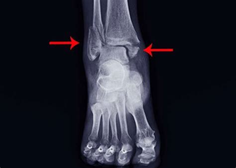 Fracture Broken Ankle Sprain