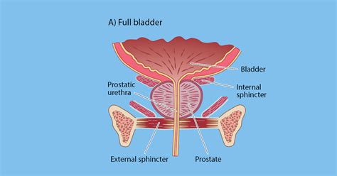 Bladder Neck Contracture | PCFA | PCFA