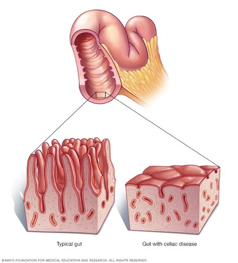 Celiac disease - Symptoms and causes - Mayo Clinic