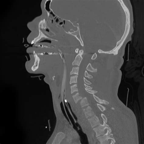 C-Spine Injuries + CT Interpretation – Core EM