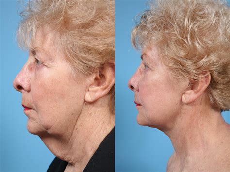 Neck Lift Before & After Photos Patient 67 | Chicago, IL | TLKM Plastic ...