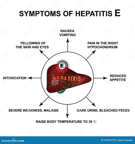 Symptoms of Hepatitis E. World Hepatitis Day. Infographics. Vector ...