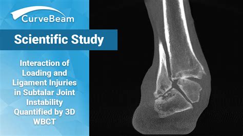 WBCT Reveals Subtalar Joint Instability Mechanisms - CurveBeam AI