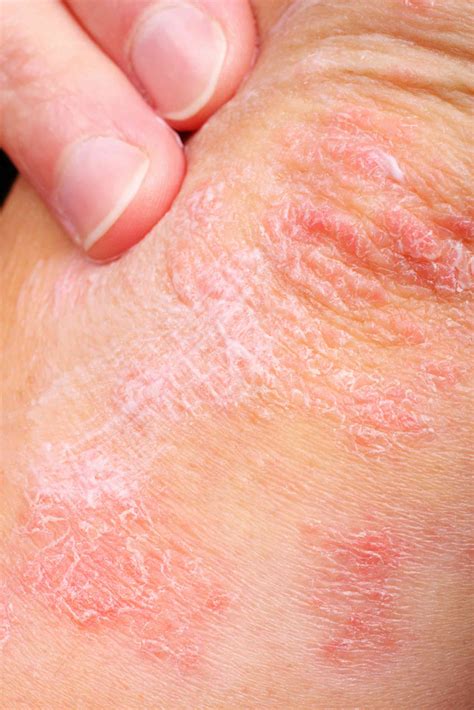 Explainer: what is eczema and what can you do about it?