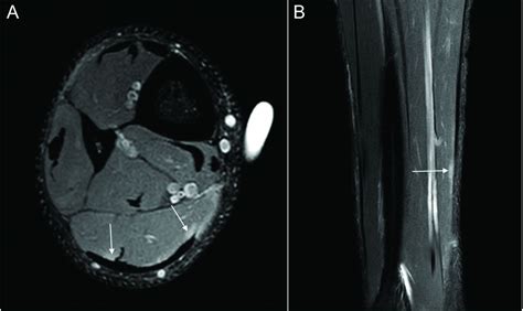 Connective tissue injury in calf muscle tears and return to play: MRI ...