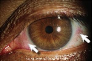 Images For Conjunctival Xerosis (Dry Eye) And Bitot's Spot ~ YOUNG ...