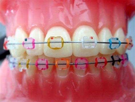 Clear Braces With Coloured Bands – Warehouse of Ideas