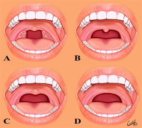 The Uvula: Conditions that Dental Hygienists can Observe during an Exam ...