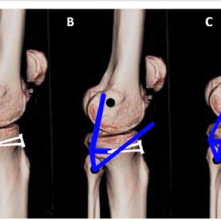 Technique of PLC reconstruction. a Semitendinosus tendon autograft ...