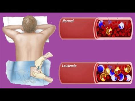 Leukemia Survival Rates: By Age - YouTube