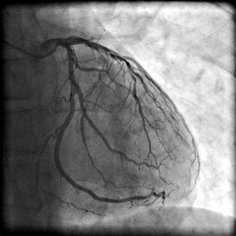 Coronary Angiogram - Dr Diana Holdright