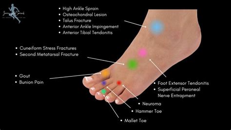 Foot Pain Chart: Top of Foot, Side and Front of Foot Pain Chart