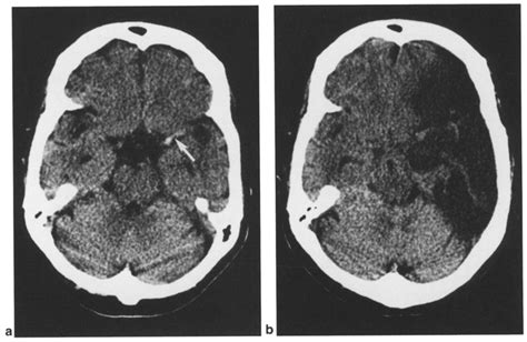 Hyperdense MCA Sign Radiology Blog Post, 40% OFF