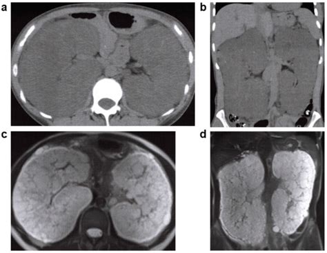 JCM | Special Issue : Cystic Kidney Disease: Clinical Diagnosis ...