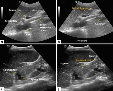 Pancreas Ultrasound Labeled