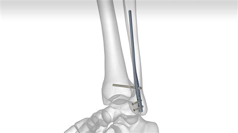 Tibia And Fibula Fracture Surgery