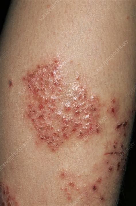 Infected eczema - Stock Image - M150/0258 - Science Photo Library