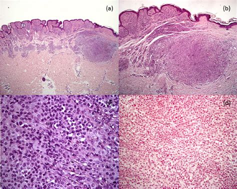 Histological findings. (a) Junctional and dermal melanocytic congenital ...