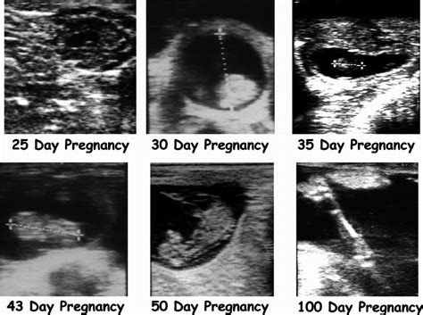 Ultrasound images of embryo or fetal development at various stages of ...