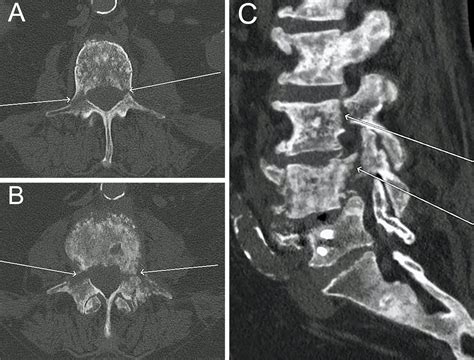 Ct Scan Lumbar Spine