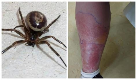 Black Widow Spider Bite Images / Common Spider Bite Symptoms Household ...