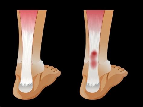 Ewing's Sarcoma: Symptoms, Treatment, & Prevention - TV Health