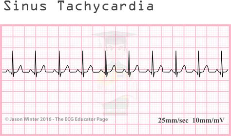 ECG Educator Blog : Sinoatrial Node rhythms