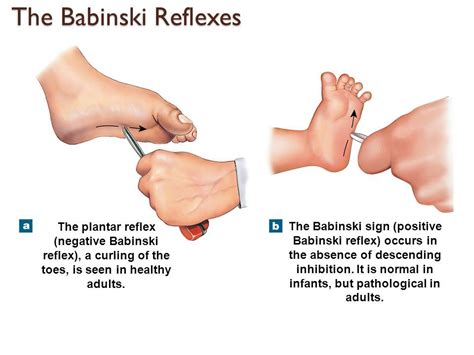 The Babinski reflex is normal in infants but abnormal in adults. Normal ...