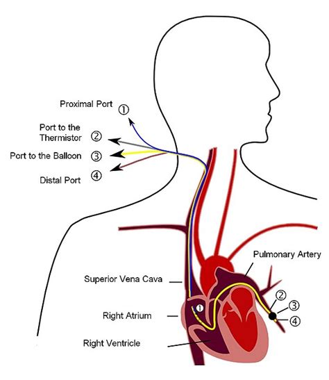 Pulmonary artery catheter - Wikipedia