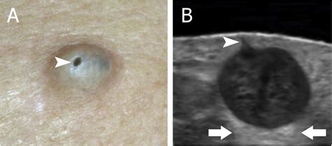 Epidermoid Cyst Icd 10