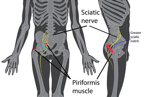 Piriformis syndrome - Wikipedia