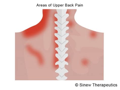 Upper Back Muscle Strains Information - Sinew Therapeutics