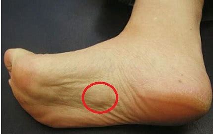 Plantar Fibromatosis aka Ledderhose Disease - Foot Pain Explored