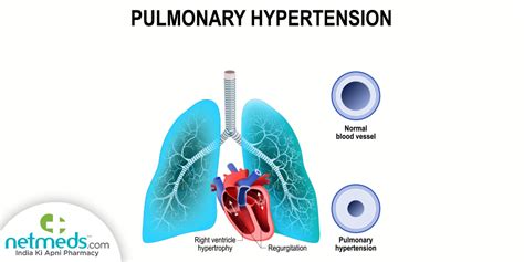 Pulmonary Hypertension: Causes, Symptoms And Treatment