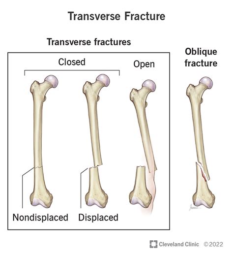 Broken Bones Through Skin