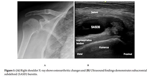 X Ray Subacromial Bursitis