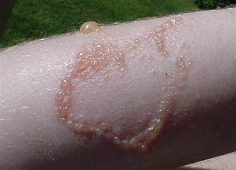 Three Myths (and Facts) About Poison Ivy Rash | Appalachian Mountain Club