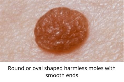 Skin Moles to Worry About – A Complete Guide With Skin Moles Pictures