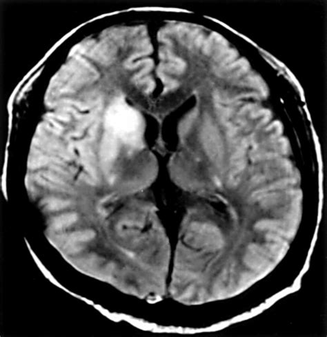 Caudate Nucleus Mri