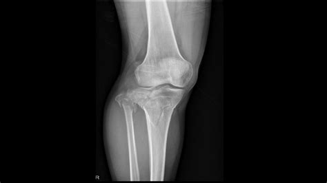 Tibial plateau fracture x ray - wikidoc