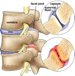 Facet Disease: Symptoms, Causes & Treatment