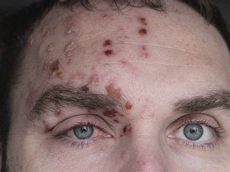 Shingles: Treatment, symptoms, causes, and when to seek help