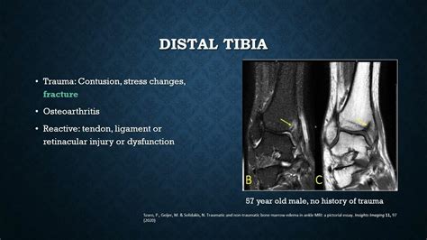 Ankle MRI Bone Marrow Edema Patterns, Part 1 | 15 Minute Radiology CME ...