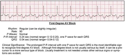 First Degree AV Block ECG - ACLS Wiki